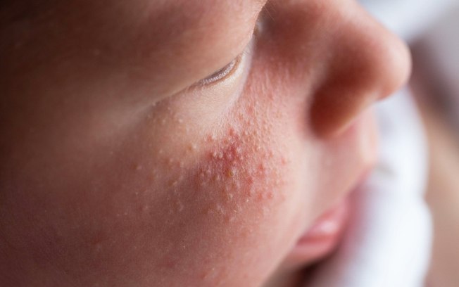 Qual a diferença entre acne neonatal e brotoeja?