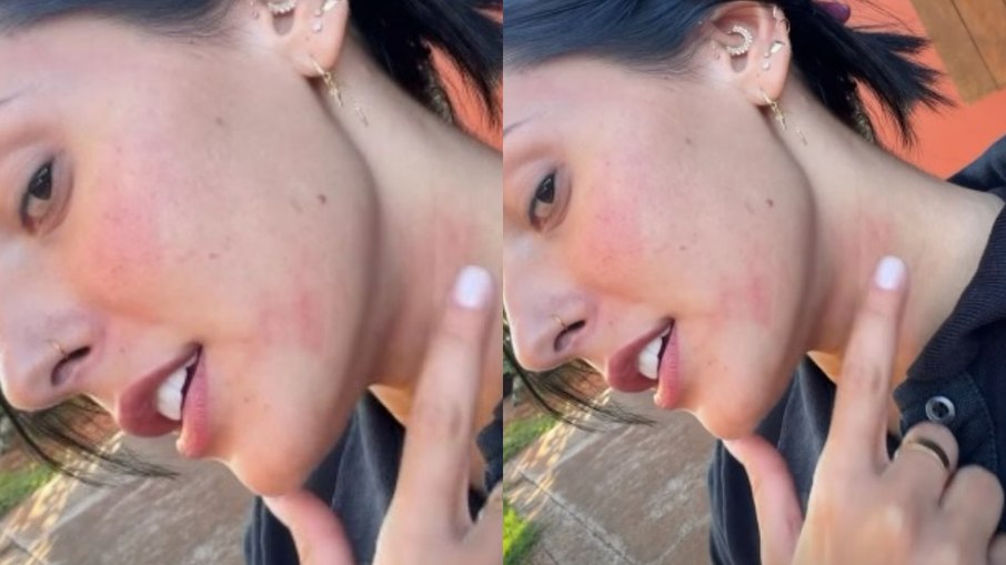 Ana Castela fala sobre alergia