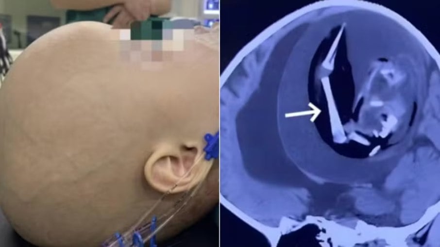 Bebê chines tem feto de irmão gêmeo alojado no cérebro