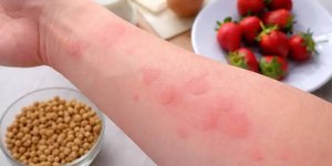 Alergia alimentar: veja sintomas, causas e quando procurar ajuda