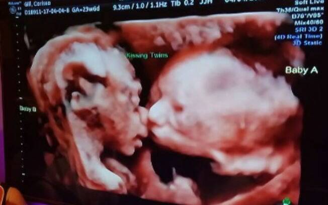 Ultrassom mostra irmãs gêmeas 'dando beijo' dentro do útero