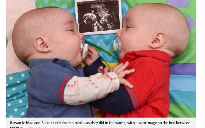 Os gêmeos idênticos corriam o risco por estarem dividindo a mesma bolsa amniótica