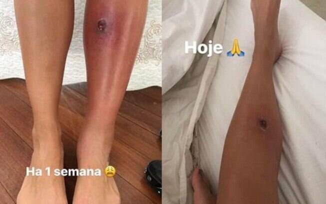 A blogueira fitness, Gabriela Pugliesi, foi infectada por erisipela e postou fotos da ferida em suas redes sociais