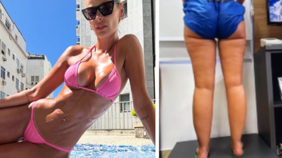 Yasmin Brunet impressiona com antes de depois de tratamento para lipedema; veja