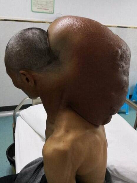 Tumor no pescoço do indiano pesava quase 15 quilos