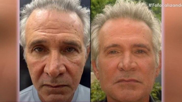 Nelson Freitas faz harmonização e mostra tendência entre homens