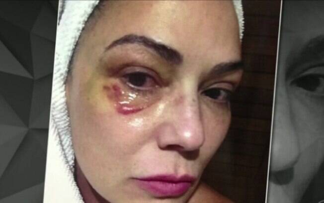 Imagem de Luiza Brunet com hematomas no rosto após suposta agressão do ex-namorado, Lírio Parissotto