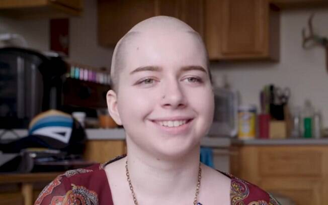 Sierra Eggum foi diagnosticada com alopecia durante o ensino médio e, na época, não se sentia bem ao olhar-se no espelho