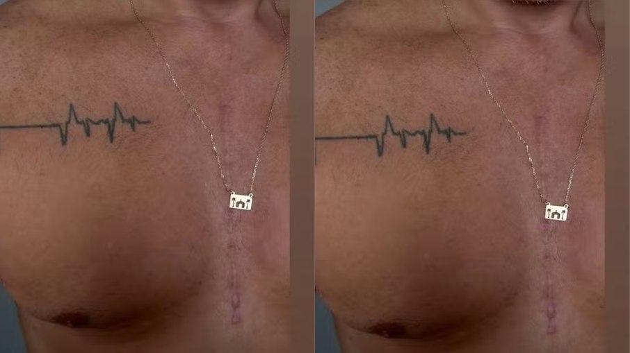 Otaviano Costa mostra cicatriz após cirurgia Otaviano Costa mostra cicatriz após cirurgia