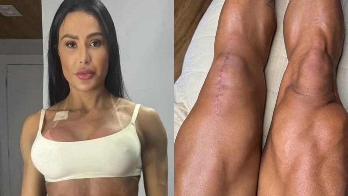 Gracyanne Barbosa Choca Fãs ao Exibir Cicatriz Após Cirurgia: Veja as Fotos!