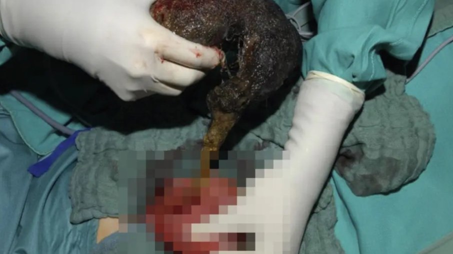 Cirurgiões retiram gigantesca bola de cabelo do estômago de menina