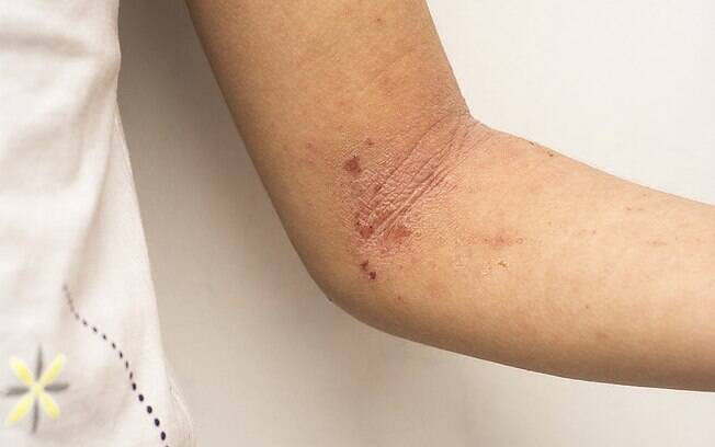 Controlar a dermatite atópica é fundamental para evitar que ela traga complicações à saúde ao longo do tempo