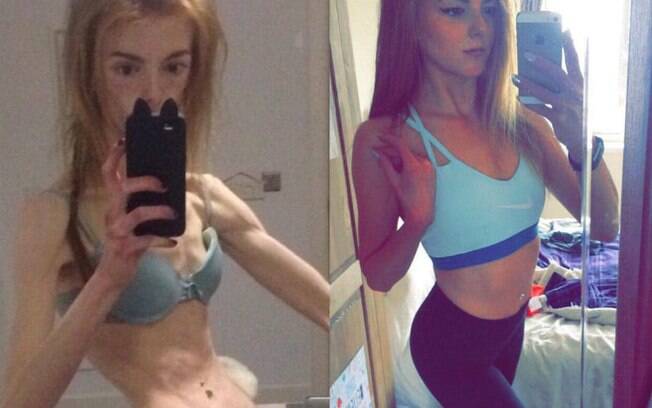 A britânica Annie Windley começou a desenvolver anorexia aos 15 anos e, na época, chegou a pesar apenas 28 kg