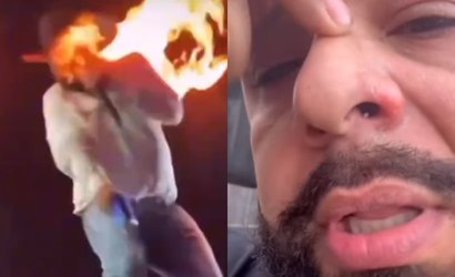 Sertanejo Léo tem rosto queimado em show em Pontal (SP)