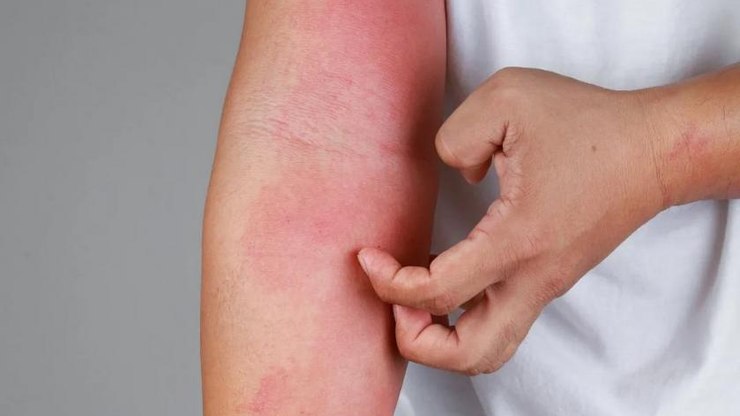 SUS passa a oferecer tratamentos contra dermatite atópica