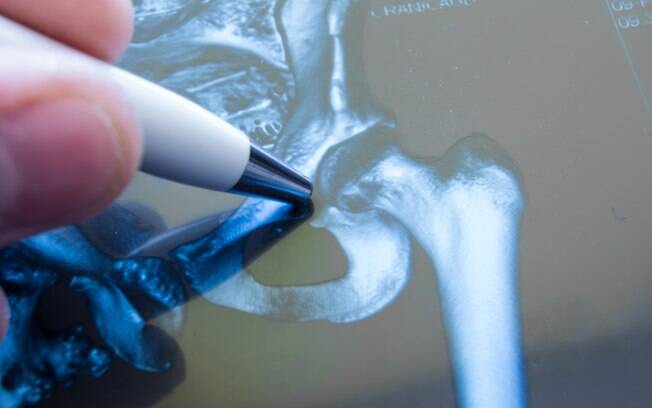 Gel que pode salvar ossos fraturados deverá ser testado em humanos nos próximos anos