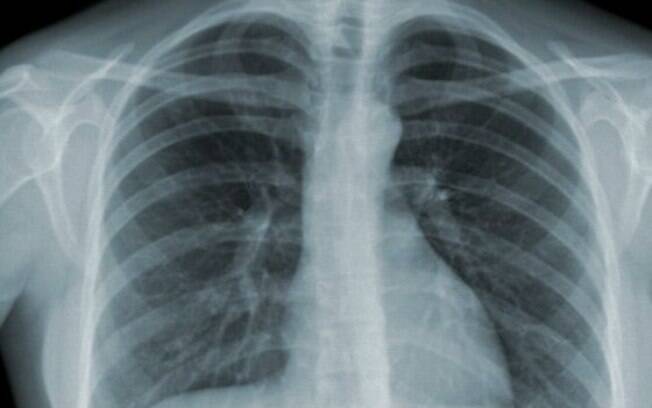 A tuberculose faz parte das doenças super-resistentes, que já fazem 700 mil vítimas por ano ao redor do mundo