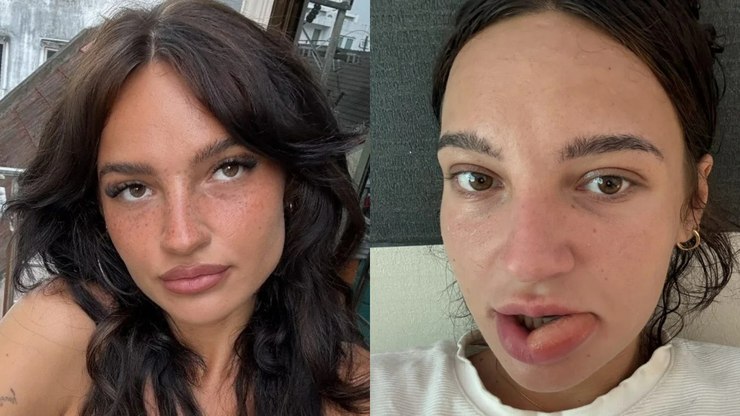 Influencer%20tem%20l%C3%A1bio%20desfigurado%20ao%20%22mastig%C3%A1-lo%22%20durante%20o%20sono