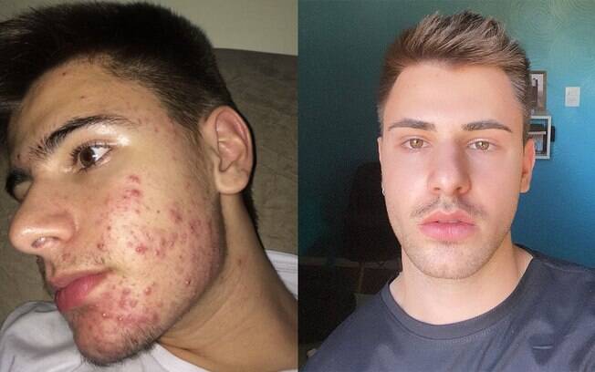Pessoas compartilham fotos do antes e depois do Roacutan e alertam para a seriedade do tratamento