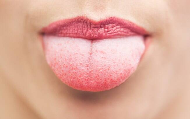 Queimar a língua pode fazer você sentir dor, queimação, inchaço e até fazer a língua mudar de cor