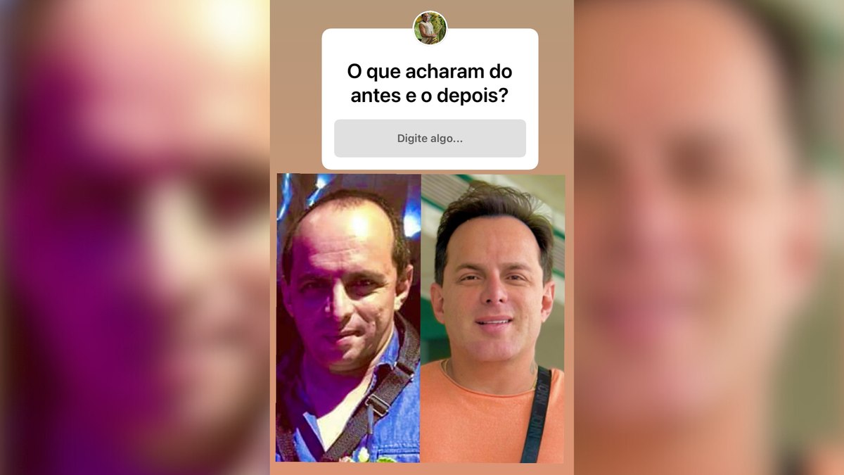 Marido de Gretchen impressiona com antes e depois de transformação facial