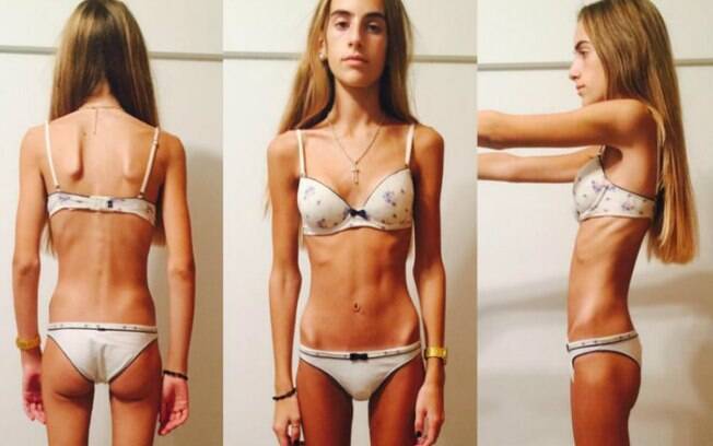 Por conta da anorexia, a argentina Delfina Carle, de 17 anos, chegou a pesar apenas 35 kg, mas conseguiu vencer a doença