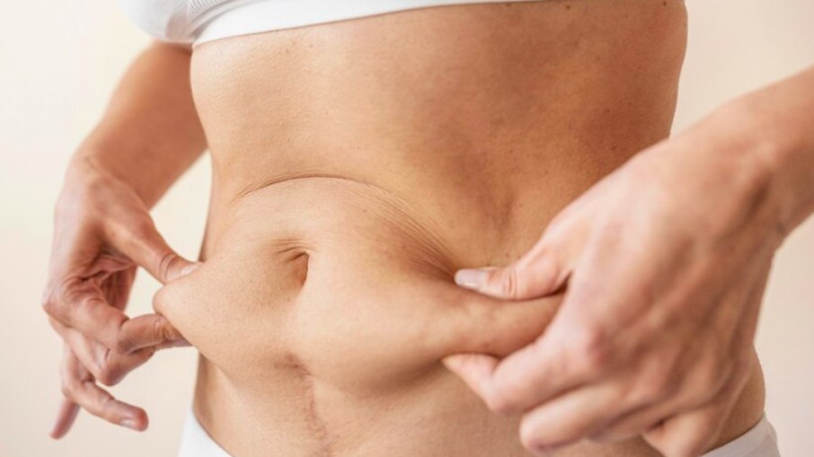 A flacidez abdominal causa incômodo e afeta tanto homens quanto mulheres