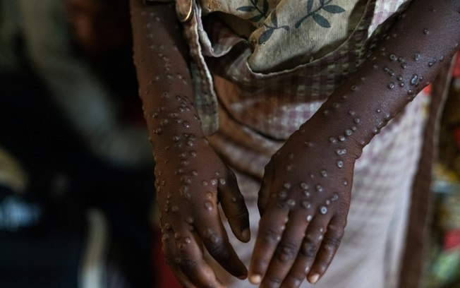 (Arquivo) Paciente infectada com mpox no hospital de Kavumu, na República Democrática do Congo, em 24 de agosto de 2024 (Arquivo) Paciente infectada com mpox no hospital de Kavumu, na República Democrática do Congo, em 24 de agosto de 2024