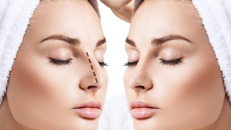 Rinoplastia estruturada alia forma e função na cirurgia do nariz