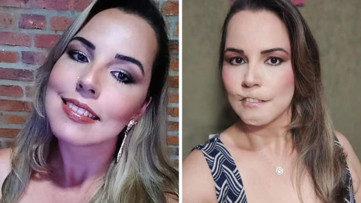 Mariana Michelini fez preenchimento labial com PMMA