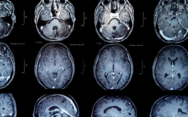 Tumores cerebrais têm uma probabilidade de quase 100% de recidiva em algum momento