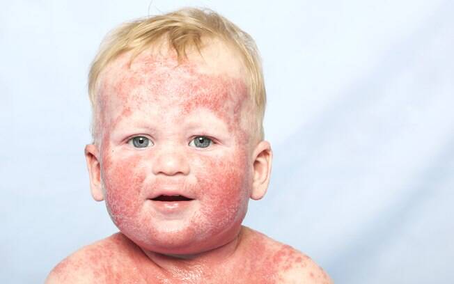 Crianção são as mais afetadas pela dermatite atópica; até os dois anos, o rosto fica vermelho e com lesões