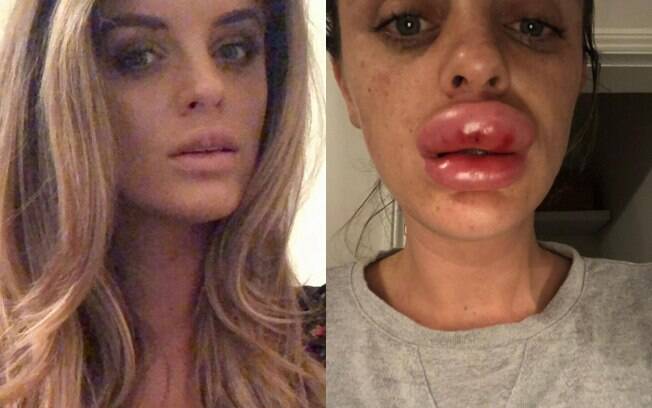 Rachel Knappier fez um preenchimento labial em um festa e ficou com os lábios cinco vezes mais inchado do que o normal
