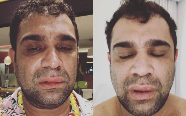 Evandro Santo afirmou pelo Instagram que foi agredido após um show de comédia em Marília, São Paulo Evandro Santo