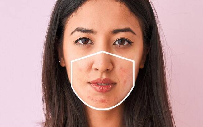 Uso excessivo de máscara está gerando acnes e outras dermatites
