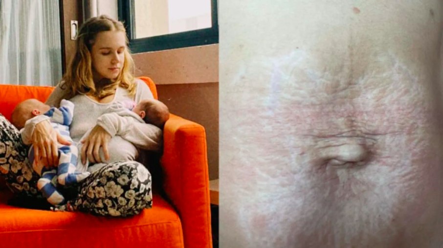 Isa Scherer mostrou a barriga um mês após o parto dos gêmeos