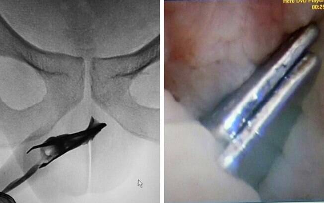 Paciente da Arábia Saudita passou por procedimento para retirar uma pinça que estava em sua uretra há quatro anos