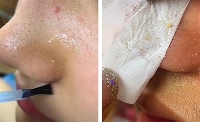 Esmalte para tirar cravos é uma boa? Dermatologista responde