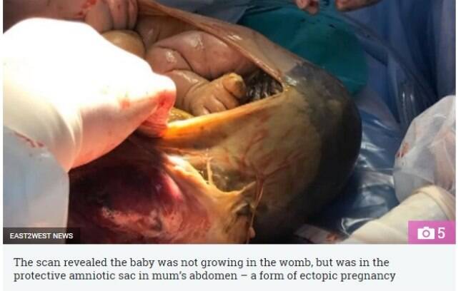 Foram necessários dez profissionais para fazer uma cirurgia de alto risco e conseguir tirar o bebê de dentro da mãe