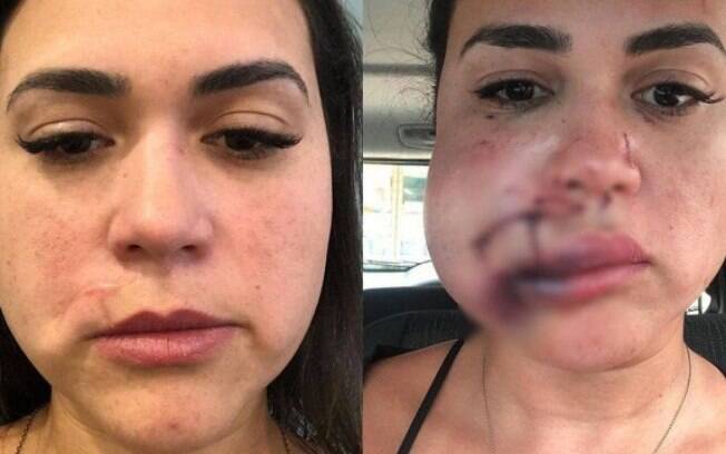 Milka foi atingida por copo no rosto e publicou resultado da cirurgia nas redes