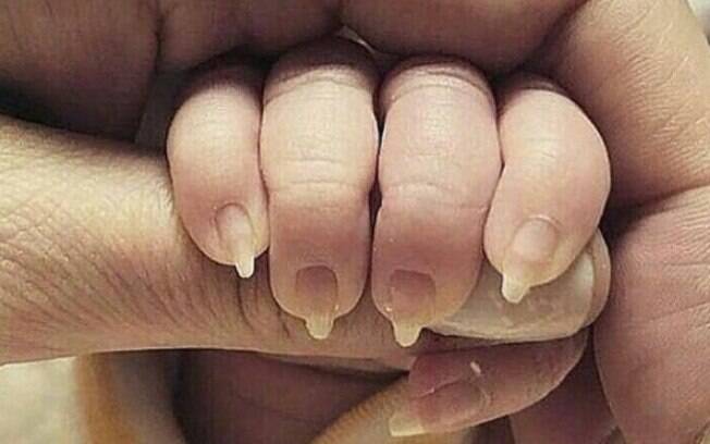 Foto de unha de bebê em formato de garra causa alvoroço em rede social