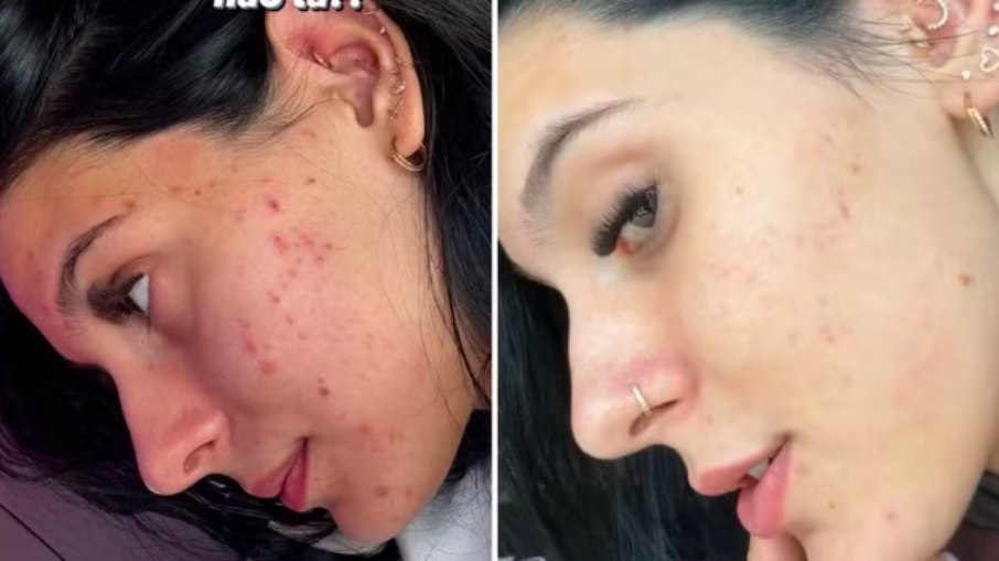 Ana Castela mostrou o antes e depois de seu tratamento para acne