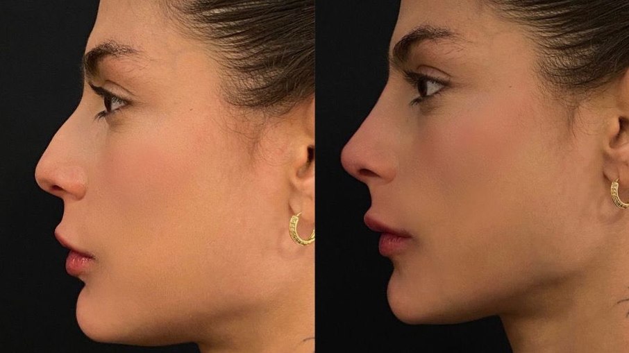 Mari Gonzalez mostra antes e depois de procedimento do nariz; veja