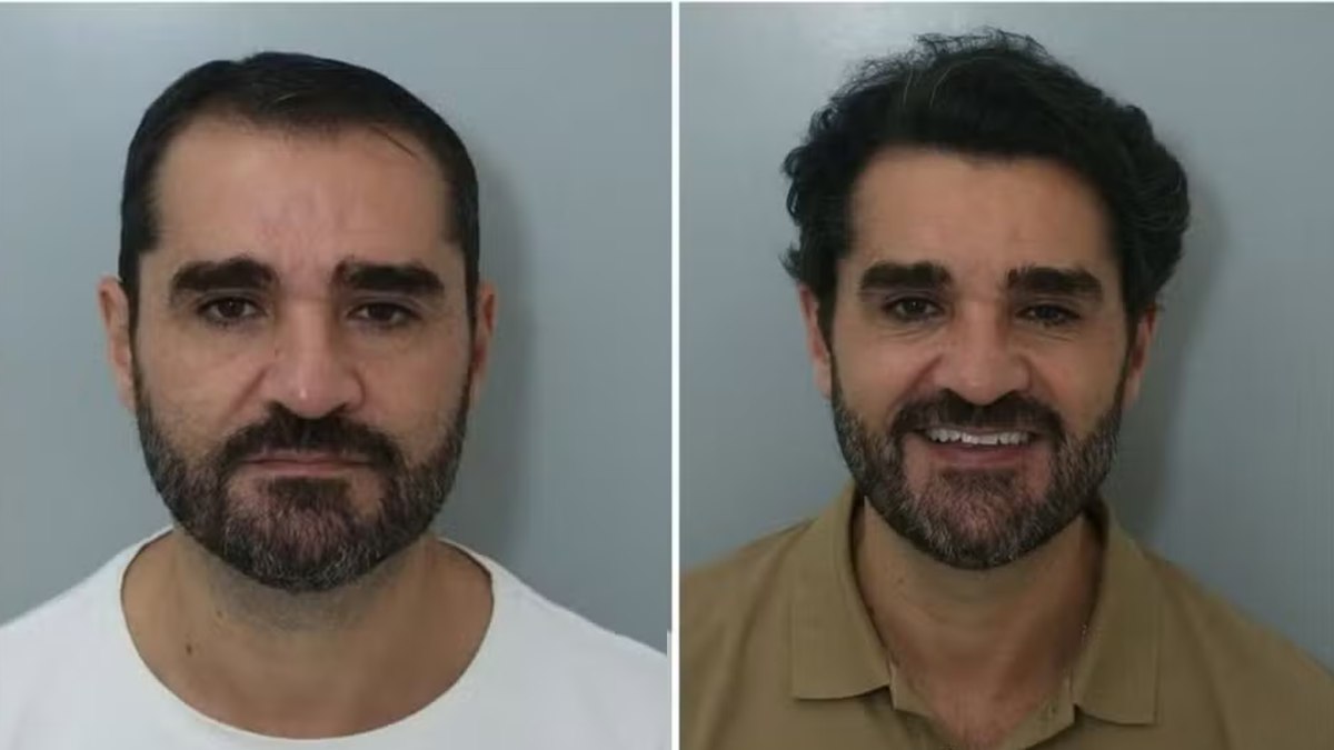 Apresentador da GloboNews faz transplante capilar veja antes e depois Apresentador da GloboNews faz transplante capilar veja antes e depois