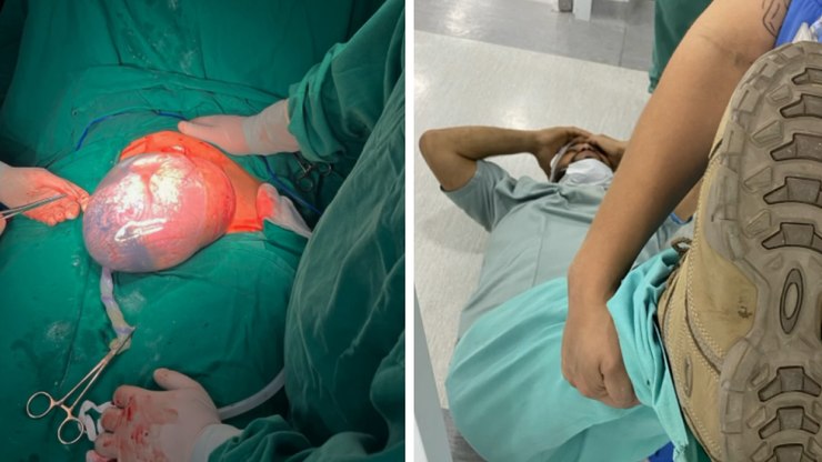 Dois bebês empelicados nascem em menos de 48h em hospital de SC