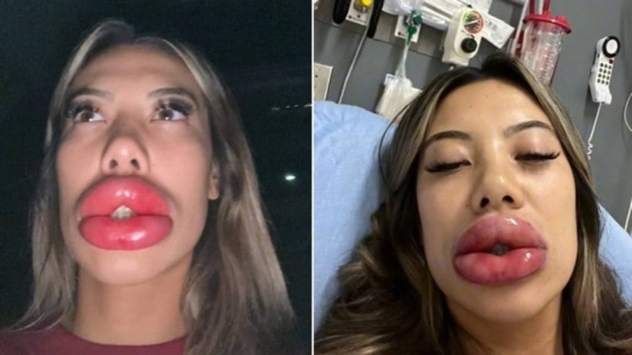 Basia Query viralizou no TikTok ao postar um vídeo em que aparece com os lábios extremamente inchados