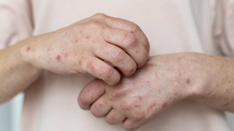Estão entre os sintomas da doença febre alta e manchas vermelhas pelo corpo Estão entre os sintomas da doença febre alta e manchas vermelhas pelo corpo