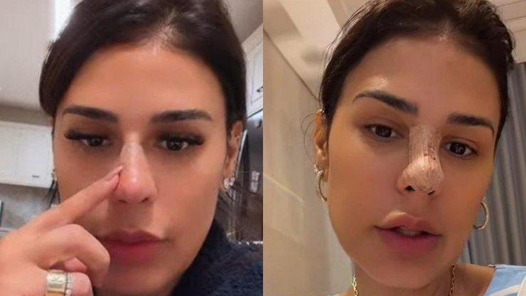 Simone Mendes nega cirurgia ao aparecer com nariz diferente