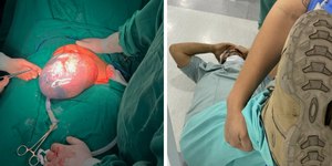 Dois bebês empelicados nascem em menos de 48h em hospital de SC