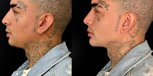 MC Guimê surpreende ao mostrar antes e depois de harmonização